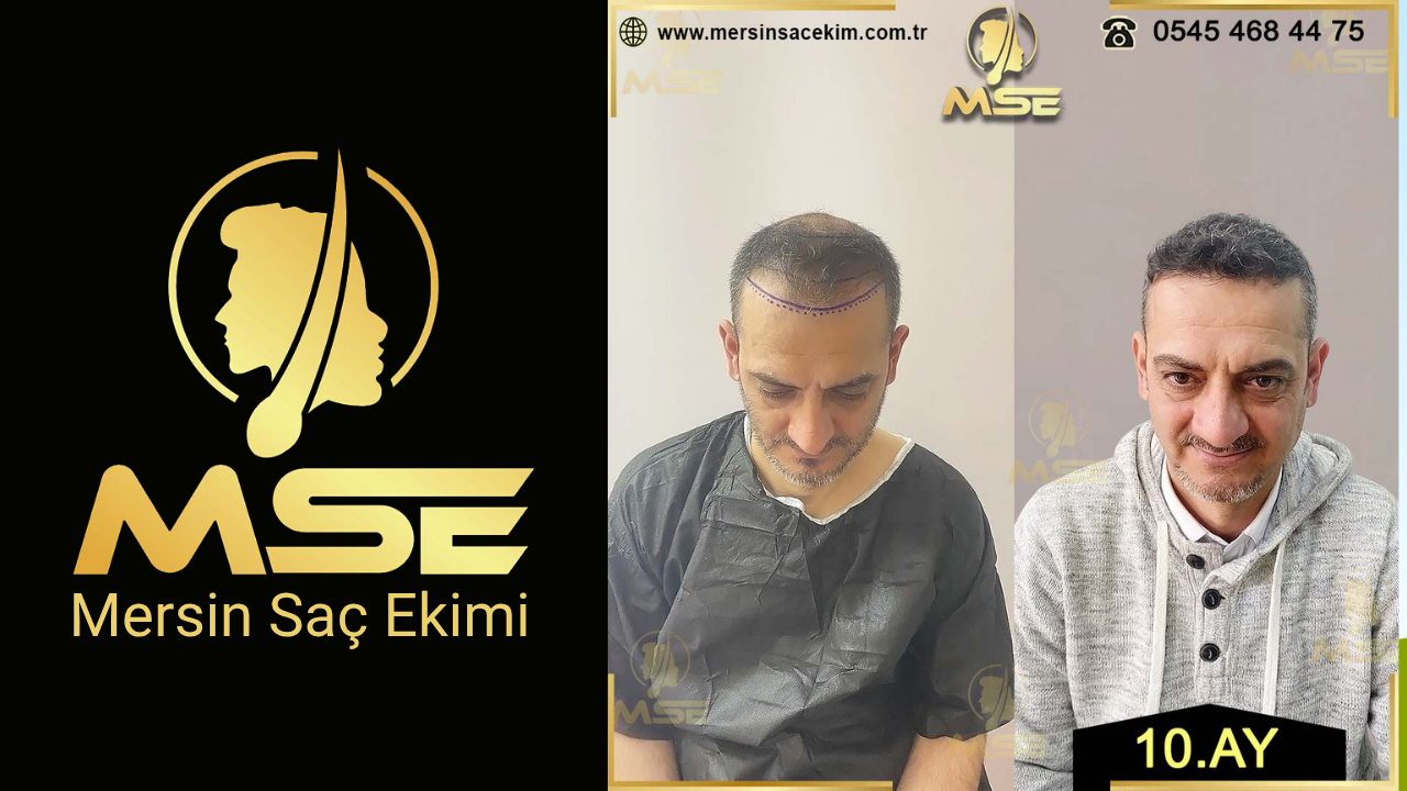 MERSİN SAÇ EKİMİ